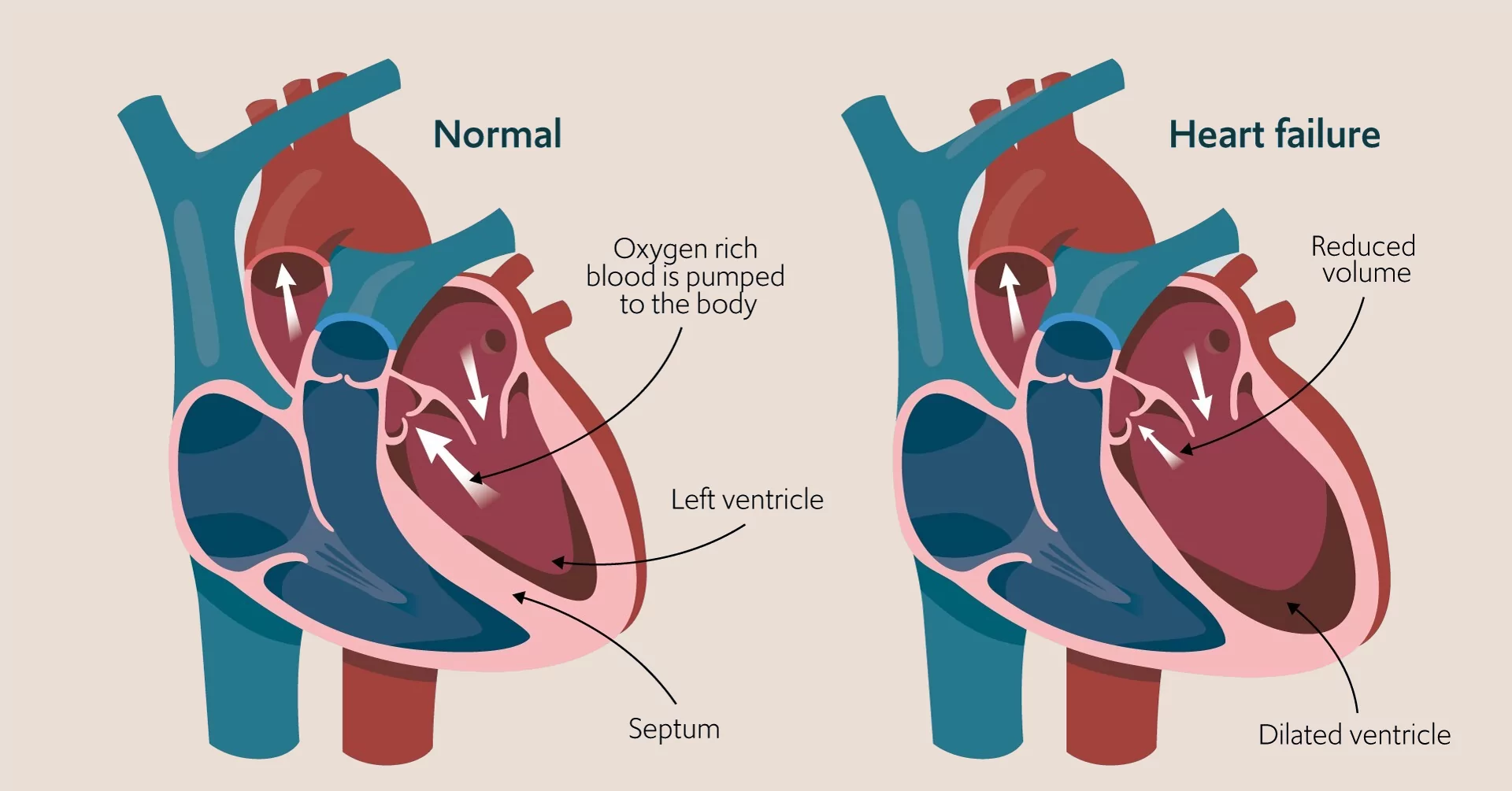 Heart Disease Prediction Demo
